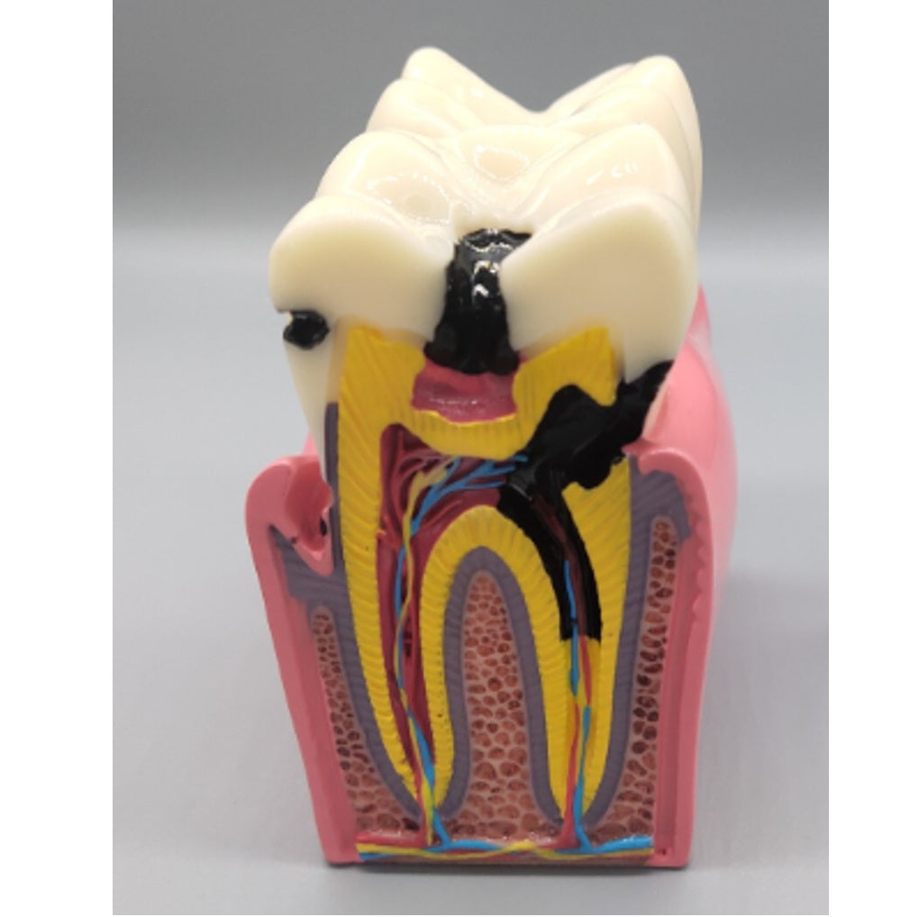 Dental Caries Comparison Model