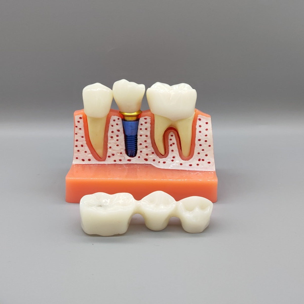 Dental Implant Educational Model