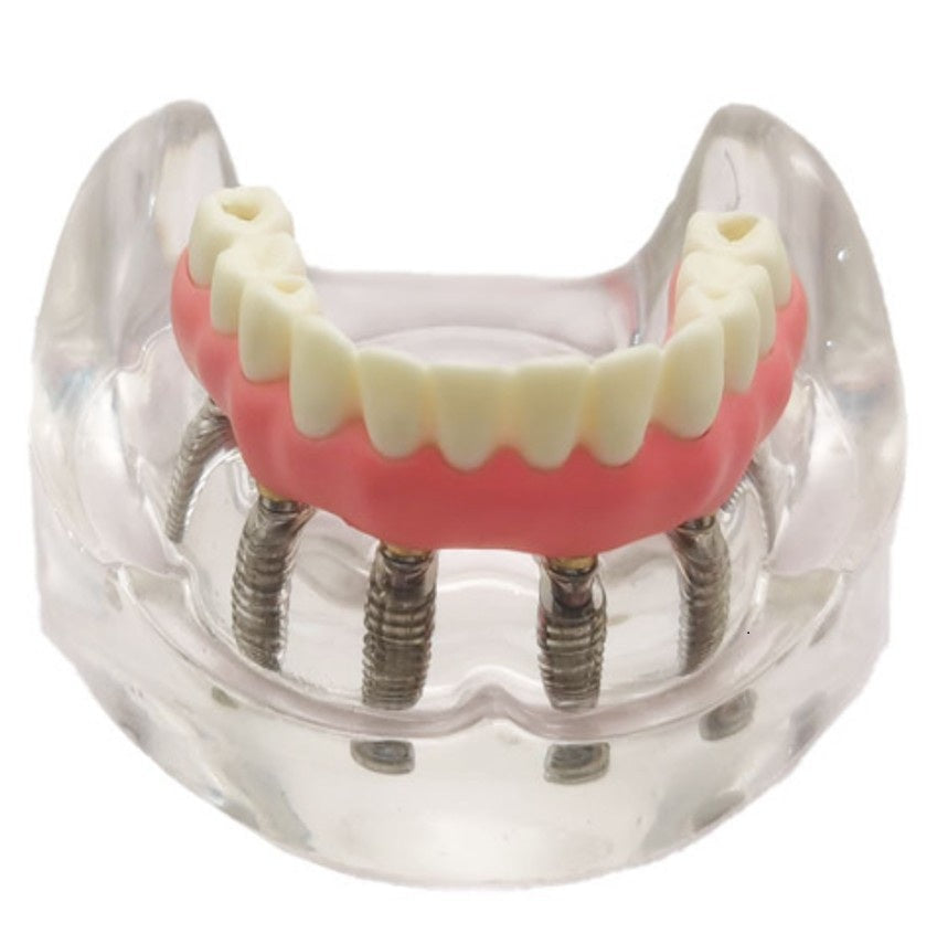Malone Bridge Educational Model – 6 Implants