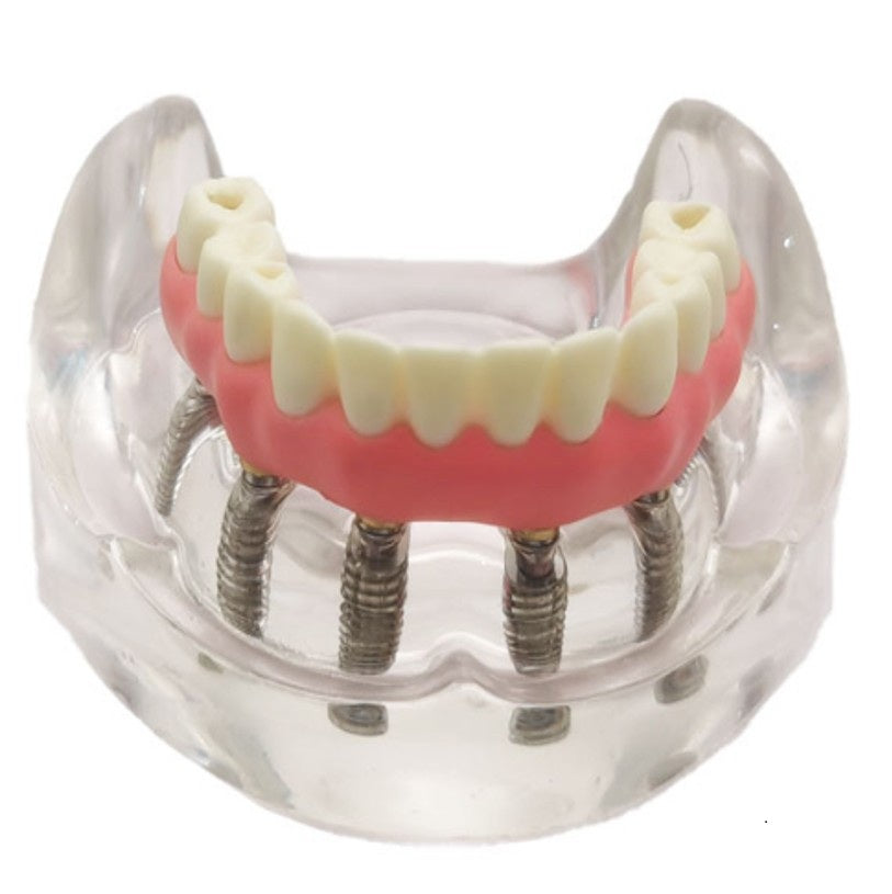 Malone Bridge Educational Model – 4 Implants